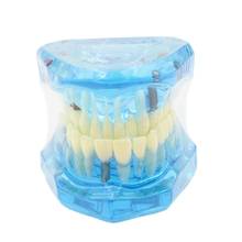1pcs Dental Model teeth implant Restoration Bridge Teaching Study Tooth Medical Science Disease Study Dentist Dentistry products 2024 - buy cheap