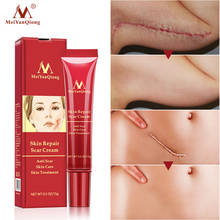 MeiYanQiong Removal Scar Repair Gel Face Cream Acne Spots Acne Treatment Anti Scar Stretch Marks Body Skin Cream 15g 2024 - buy cheap