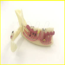 Orthodontic Braces Dental Mandibular Tissue Teeth Demonstration Anatomical Model Patient Study Teach Model 2024 - buy cheap