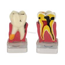 1Pcs Oral dental teeth model 4 times transparent molar profile model with nerve For Dental Lab dental teaching 2024 - buy cheap