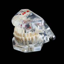 Dental dental restoration and dental implant model for dentistry and dental disease teaching 2024 - buy cheap