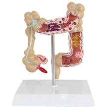 Colorectal Lesion Model Human Colon Large Intestine Pathological Diseases Model Medical Mrganizer Anatomy 2024 - buy cheap