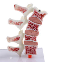 1:1 Human Medical Lumbar Vertebra Thighbone Osteoporosis Pathology Model Kit 2024 - buy cheap