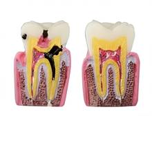 Modelo anatômico das válvulas para comparação de dentes, 6 vezes, modelo m4021 mostra a superfície anatômica normal dos dentes/dental, modelo de ensino m4021 2024 - compre barato