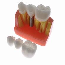 Modelo de dientes con análisis de implantes, puente de corona, modelo extraíble, modelo de dientes de estudio Dental 2024 - compra barato