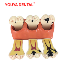 Modelo dental dentes modelagem 4 vezes cárie desenvolvimento modelo de ensino para estudar ciência médica dentista oral odontologia produtos 2024 - compre barato
