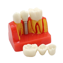 Dental Teach Implant Analysis Crown Bridge Removable Model Dental Teeth Model Teaching study Dentist Model Free shipping 2024 - buy cheap