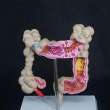 Anatomical Human Colon large Intestine Pathological Diseases Model Medical Organ Anatomy Teaching Resources 2024 - buy cheap