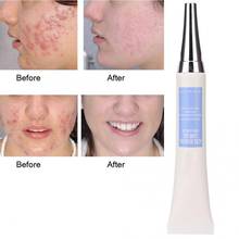 20g Acne Treatment Blackhead Removal Anti Acne Comedo Cream Acne Scar Remover Repairing Face Cream Whitening Cream Skin Care 2024 - buy cheap