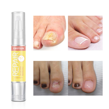 Fungal-Esencia de tratamiento de uñas de alta calidad, líquido blanqueador, eliminación de hongos de las uñas de los pies, herramienta artística para el cuidado de las uñas de los pies 2024 - compra barato