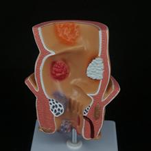 Anatomical Human Rectum Pathology Lesion Model Hemorrhoids Anus Medical Teaching Rectal Learning Teaching Resources 2024 - buy cheap