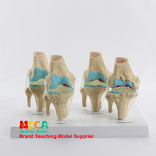Mgj007 modelo de esqueleto combinado, quatro tipos de articulações de joelho, doença osso do joelho, modelo de caixa ortopédica, ensino de medicina 2024 - compre barato