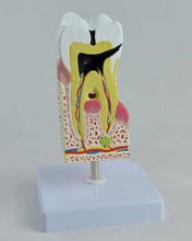 2X enlarge Tooth decay model Tooth pathology anatomy section model educational teaching model 2024 - buy cheap