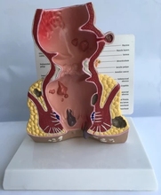 Anatomical model of appendix and cecum Medical teaching model Human anorectal pathological model 2024 - buy cheap