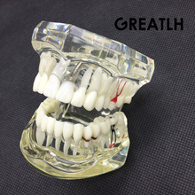 Modelo de dentes para implante dentário, modelo com elo de restauração, dentista para doença dentária da ciência, estudo de ensino 2024 - compre barato