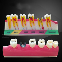 Dental caries classify model Tooth Model Demonstration Teach Study Dental teeth caries Evolution decayed tooth Analysis Model 2024 - buy cheap
