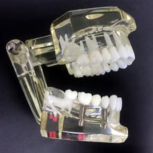 Dental Implant Disease Teeth Model With Restoration Bridge Malocclusion Orthodontic Model For Medical Science Dental Research 2024 - buy cheap