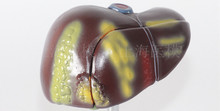 Modelo de fígado fígado patologia modelo modelo modelo de doença hepatobiliar de carcinoma da cirrose hepática fígado gordo 2024 - compre barato