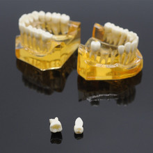 Dientes extraíbles dentales para adultos, modelo Typodont, enfermedad de implante, equipo de laboratorio para dentistas 2024 - compra barato
