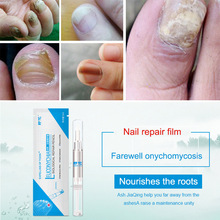 Feet Nail Repair Nutritious Oil Fungus Removal Polish Armor Beauty Pen Useful For Nursing  MSI-19 2024 - buy cheap