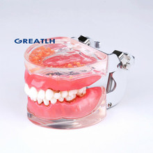 Dental Adult Pathological Periodontal disease 4017#  Dental Typodont Teeth Model 2024 - buy cheap
