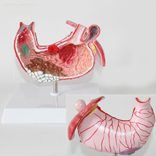 stomach Anatomical model  Gastric Distal Model Stomach Gastric Common Diseases 2024 - buy cheap