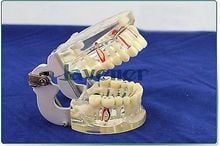 Dental Disease Tooth Teaching Model Pathology Periodontal Diseases Dental Caries 2024 - buy cheap