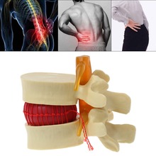 Anatomical Spine Lumbar Disc Herniation Anatomy Medical Model Teaching Tool School Supplies Medical Instrume C26 2024 - buy cheap