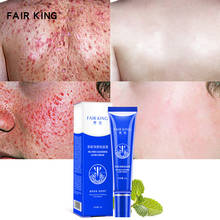 Face Care Tools Tea Tree Cleansing Acne Cream Face Anti Acne Treatment Cream Moisturize Control Oil Skin Care Face Acne Repair 2024 - buy cheap