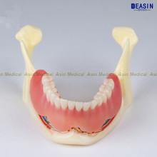 Cinto para cobertura de dentaduras, modelo dentário de resina mandibular para cobertura de dentaduras modelo de correia de mandíbula 2024 - compre barato