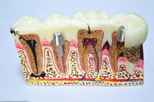 Materiais odontológicos patologia dissecção modelo decaied dente gengival dissecção frete grátis 2024 - compre barato