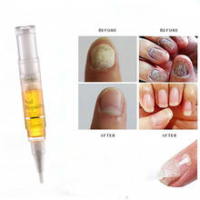 Nail Care Repair Treatment Liquid Pen Mycosis, Paronychia Antifungal Nail Infection Toe Nail Care Fungal Nail Treatment TSLM1 2024 - buy cheap
