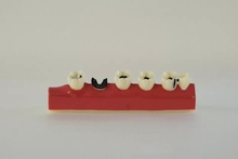 Nuevo modelo de análisis de Caries Dental, modelo de diente para la enfermedad peridontal 2024 - compra barato