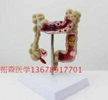 Modelo de órgano humano modelo patológico Colorectal modelo enseñanza medicina Mould envío gratis 2024 - compra barato