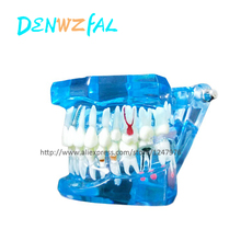 Modelo de comunicação de paciente oral, modelo de patologia descartável para implante dentário 2024 - compre barato
