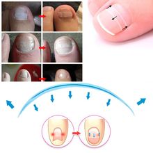 10Pcs Ingrown Toenails Treatment Straightening Tape Curved Clip Brace Patch Nail Wedge Paronychia Lifter Recover Tape 2024 - buy cheap