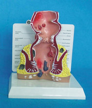 Modelo Rectal rectal de agrandamiento de lesiones rectales 2024 - compra barato