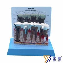 Teeth model Enlarged version Oral pathology model of dental dental disease implant restoration model 2024 - buy cheap