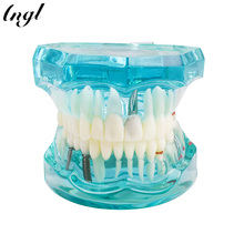 1 Piece Adult Dental Resin Restoration Model Teeth Study Model Dentist Tools Dentistry Laboratory Transparent Model 2024 - buy cheap