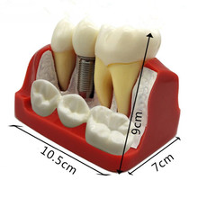 4 Times Dental Implant Disease Analysis with Restoration Crown Bridge Demonstration Dental Teeth Model Teaching study M 2024 - buy cheap