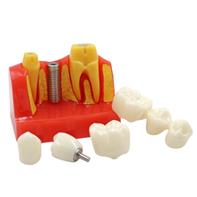 Стоматологический имплантант четыре раза обучающая модель зубов 4 раза Стоматологическая Смола кварцевые Резиновые Зубы Модель стоматолога обучение Патологии Модель 2024 - купить недорого