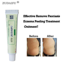 ZUDAIFU-Crema para Psoriasis corporal, sin caja de venta al por menor, cuidado de la piel 2024 - compra barato