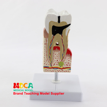 Dental anatomy model, tooth enlargement, tooth decay, gingival display, medical teaching model MYC010 2024 - buy cheap
