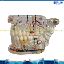 New dental implant teeth model with nerve Transparent pathological Repair model Teaching demonstration model 2024 - buy cheap