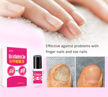 Tratamento fúngico do fungo do dedo do pé erval chinês do prego da infecção do fungo do prego do anti 2024 - compre barato