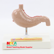 Pathological gastrointestinal model human gastric lesions teaching aids digestive system medicine teaching MCW008 2024 - buy cheap