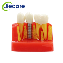 1 pc dental material 4 vezes dentes implante modelo de doença dentes modelo com restauração ponte coroa para estudo médico 2024 - compre barato