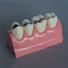 Caries treatment model dental tooth teeth anatomical anatomy dentist model odontologia 2024 - buy cheap