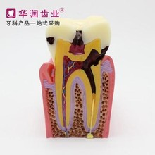 Modelo Dental de odontología, 6xcaries, modelo de cavidad oral, envío gratis 2024 - compra barato