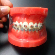 Modelo ortodôntico dos dentes, modelo com suporte totalmente de metal, modelo ortodôntico de alta qualidade com suporte para os dentes 2024 - compre barato